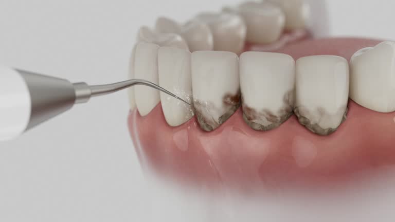 Reliable Tooth Extraction contractor in Orchard Homes, MT by Smile Center Dentistry